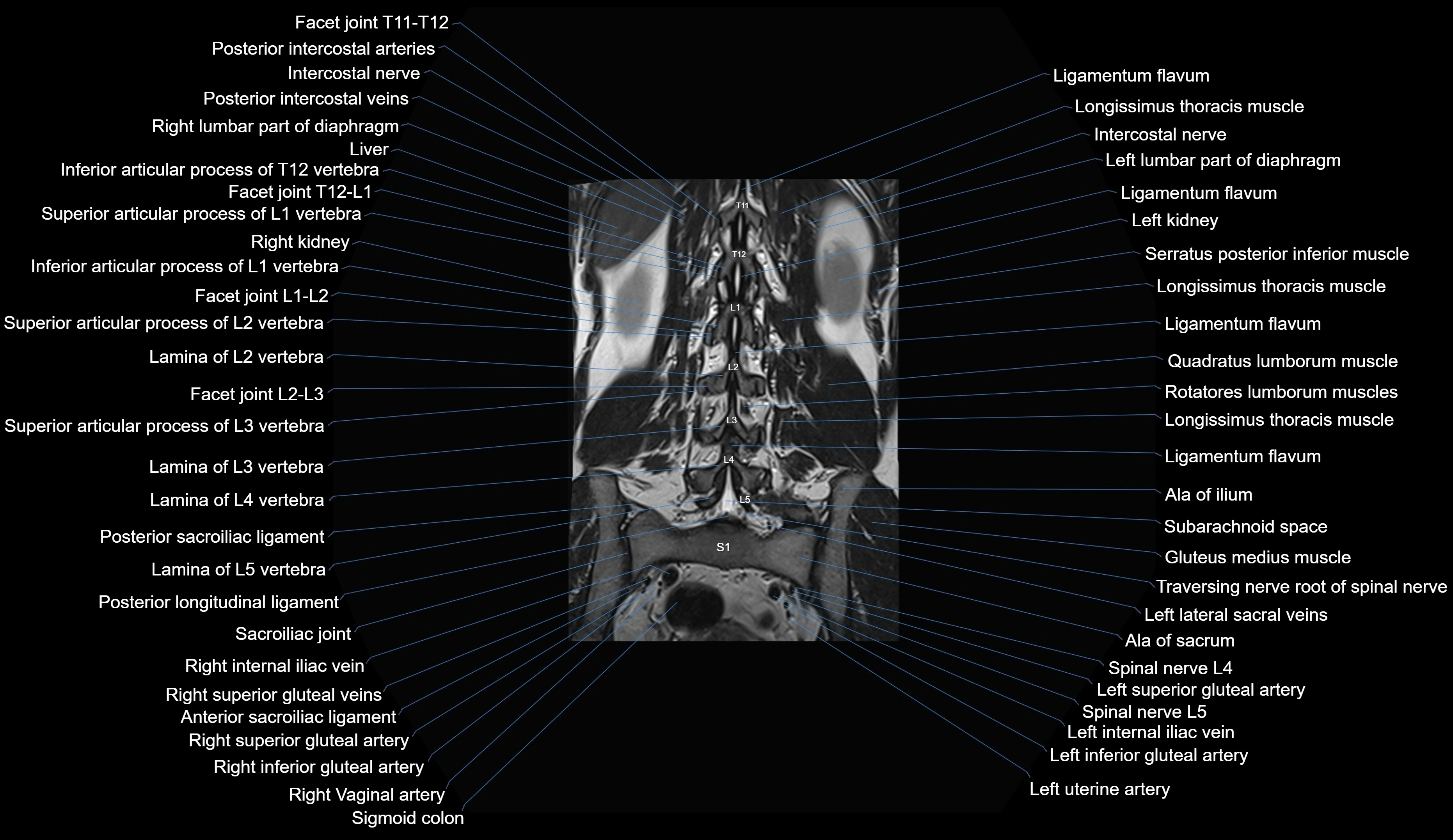 MRI lumbar spine coronal cross sectional anatomy 3T radiology  image-img-00001-00023.webp